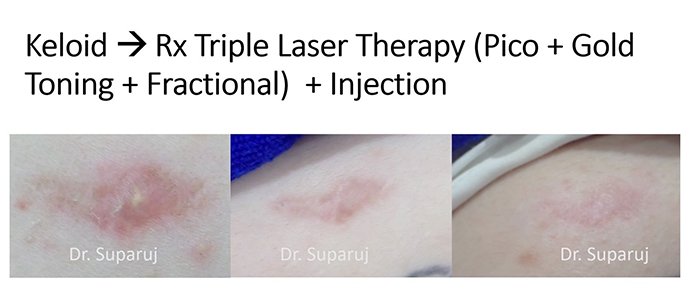 ดูแลแผลเป็นยุบตัวจากอุบัติเหตุ Traumatic/ Atrophic scar ได้อย่างไรบ้าง? ดูแลแผลเป็นยุบตัวจากอุบัติเหตุ Traumatic/ Atrophic scar ได้อย่างไรบ้าง?