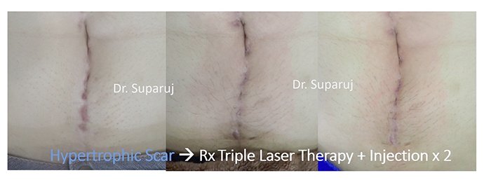 ดูแลแผลเป็นยุบตัวจากอุบัติเหตุ Traumatic/ Atrophic scar ได้อย่างไรบ้าง? ดูแลแผลเป็นยุบตัวจากอุบัติเหตุ Traumatic/ Atrophic scar ได้อย่างไรบ้าง?
