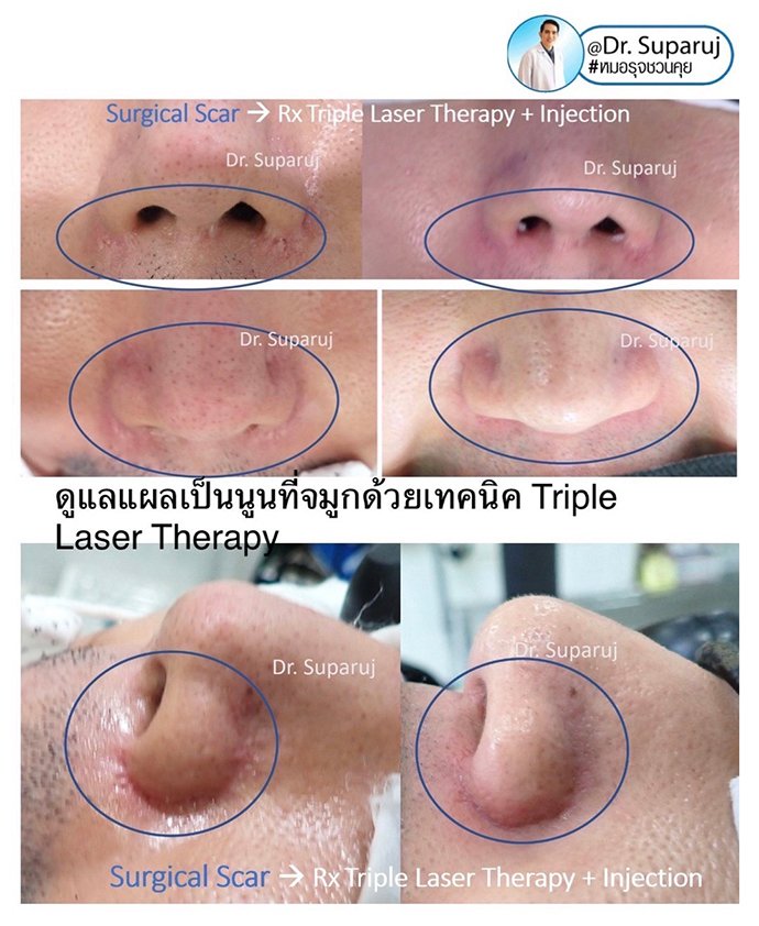 ดูแลแผลเป็นยุบตัวจากอุบัติเหตุ Traumatic/ Atrophic scar ได้อย่างไรบ้าง?