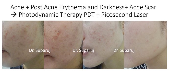 แนะนำเทคนิคดูแลปัญหาผิวหนัง Ep.8: สิวจากการใส่หน้ากาก หรือ Maskne วินิจฉัยได้อย่างไร ดูแลรักษาได้อย่างไร? แนะนำเทคนิคดูแลปัญหาผิวหนัง Ep.8: สิวจากการใส่หน้ากาก หรือ Maskne วินิจฉัยได้อย่างไร ดูแลรักษาได้อย่างไร?