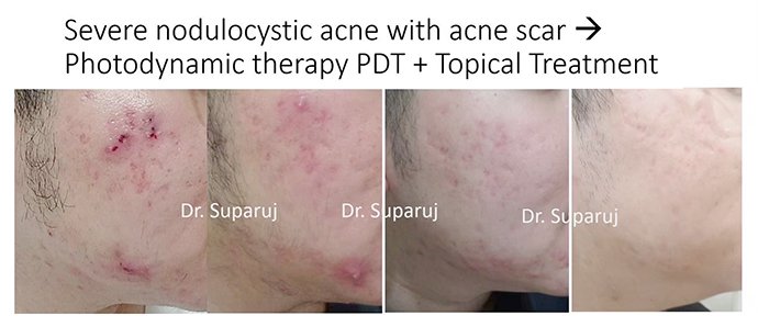 แนะนำเทคนิคดูแลปัญหาผิวหนัง Ep.8: สิวจากการใส่หน้ากาก หรือ Maskne วินิจฉัยได้อย่างไร ดูแลรักษาได้อย่างไร? แนะนำเทคนิคดูแลปัญหาผิวหนัง Ep.8: สิวจากการใส่หน้ากาก หรือ Maskne วินิจฉัยได้อย่างไร ดูแลรักษาได้อย่างไร?