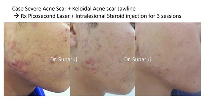 แนะนำเทคนิคดูแลปัญหาผิวหนัง Ep.8: สิวจากการใส่หน้ากาก หรือ Maskne วินิจฉัยได้อย่างไร ดูแลรักษาได้อย่างไร? แนะนำเทคนิคดูแลปัญหาผิวหนัง Ep.8: สิวจากการใส่หน้ากาก หรือ Maskne วินิจฉัยได้อย่างไร ดูแลรักษาได้อย่างไร?