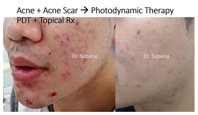 แนะนำเทคนิคดูแลปัญหาผิวหนัง Ep.8: สิวจากการใส่หน้ากาก หรือ Maskne วินิจฉัยได้อย่างไร ดูแลรักษาได้อย่างไร? แนะนำเทคนิคดูแลปัญหาผิวหนัง Ep.8: สิวจากการใส่หน้ากาก หรือ Maskne วินิจฉัยได้อย่างไร ดูแลรักษาได้อย่างไร?