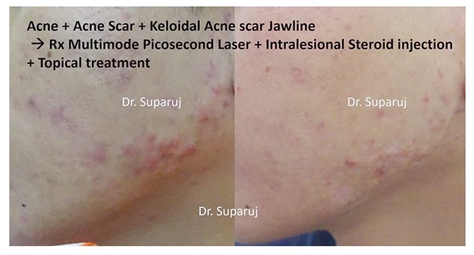 แนะนำเทคนิคดูแลปัญหาผิวหนัง Ep.8: สิวจากการใส่หน้ากาก หรือ Maskne วินิจฉัยได้อย่างไร ดูแลรักษาได้อย่างไร? แนะนำเทคนิคดูแลปัญหาผิวหนัง Ep.8: สิวจากการใส่หน้ากาก หรือ Maskne วินิจฉัยได้อย่างไร ดูแลรักษาได้อย่างไร?