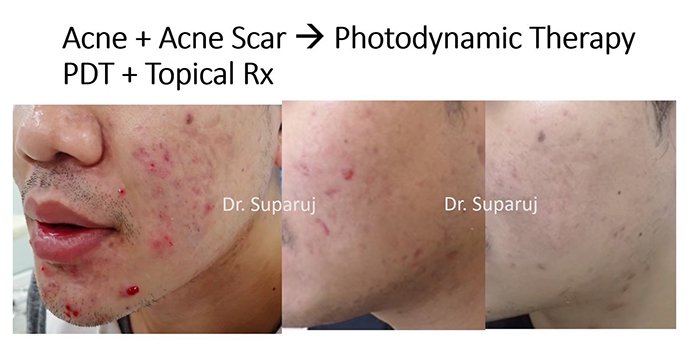 แนะนำเทคนิคดูแลปัญหาผิวหนัง Ep.8: สิวจากการใส่หน้ากาก หรือ Maskne วินิจฉัยได้อย่างไร ดูแลรักษาได้อย่างไร? แนะนำเทคนิคดูแลปัญหาผิวหนัง Ep.8: สิวจากการใส่หน้ากาก หรือ Maskne วินิจฉัยได้อย่างไร ดูแลรักษาได้อย่างไร?