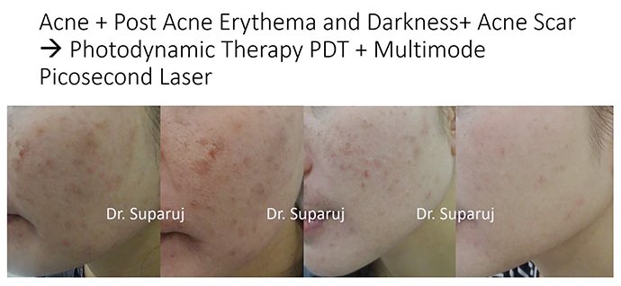 แนะนำเทคนิคดูแลปัญหาผิวหนัง Ep.8: สิวจากการใส่หน้ากาก หรือ Maskne วินิจฉัยได้อย่างไร ดูแลรักษาได้อย่างไร? แนะนำเทคนิคดูแลปัญหาผิวหนัง Ep.8: สิวจากการใส่หน้ากาก หรือ Maskne วินิจฉัยได้อย่างไร ดูแลรักษาได้อย่างไร?