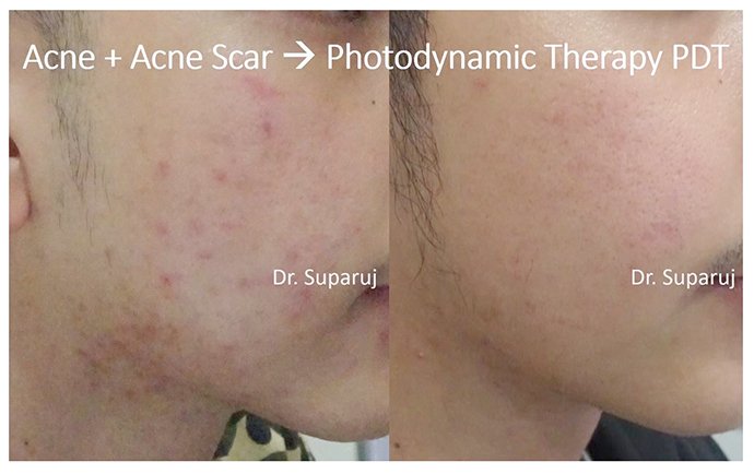 แนะนำเทคนิคดูแลปัญหาผิวหนัง Ep.8: สิวจากการใส่หน้ากาก หรือ Maskne วินิจฉัยได้อย่างไร ดูแลรักษาได้อย่างไร? แนะนำเทคนิคดูแลปัญหาผิวหนัง Ep.8: สิวจากการใส่หน้ากาก หรือ Maskne วินิจฉัยได้อย่างไร ดูแลรักษาได้อย่างไร?