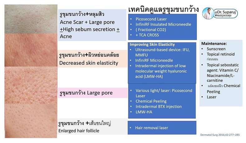 รูขุมขนกว้าง Enlarged Facial Pore เกิดจากอะไรและดูแลได้อย่างไร Part 3/3 รูขุมขนกว้าง Enlarged Facial Pore เกิดจากอะไรและดูแลได้อย่างไร Part 3/3