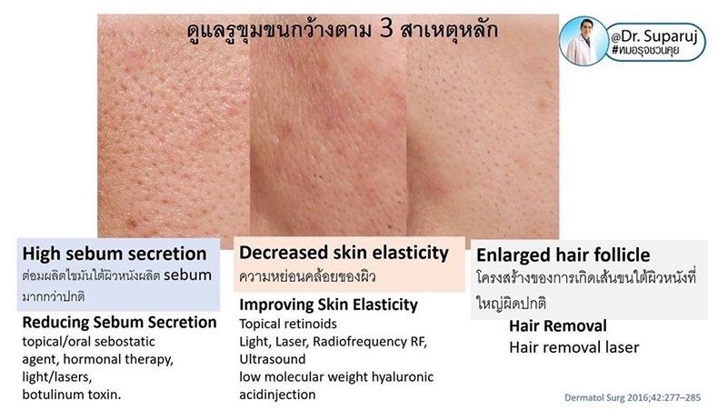 รูขุมขนกว้าง Enlarged Facial Pore เกิดจากอะไรและดูแลได้อย่างไร Part 3/3 รูขุมขนกว้าง Enlarged Facial Pore เกิดจากอะไรและดูแลได้อย่างไร Part 3/3
