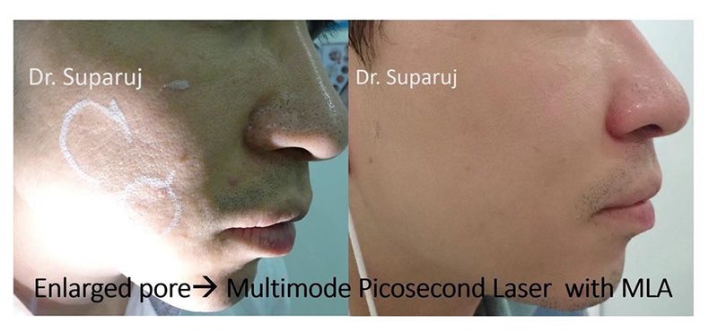 รูขุมขนกว้าง Enlarged Facial Pore เกิดจากอะไรและดูแลได้อย่างไร Part 3/3 รูขุมขนกว้าง Enlarged Facial Pore เกิดจากอะไรและดูแลได้อย่างไร Part 3/3