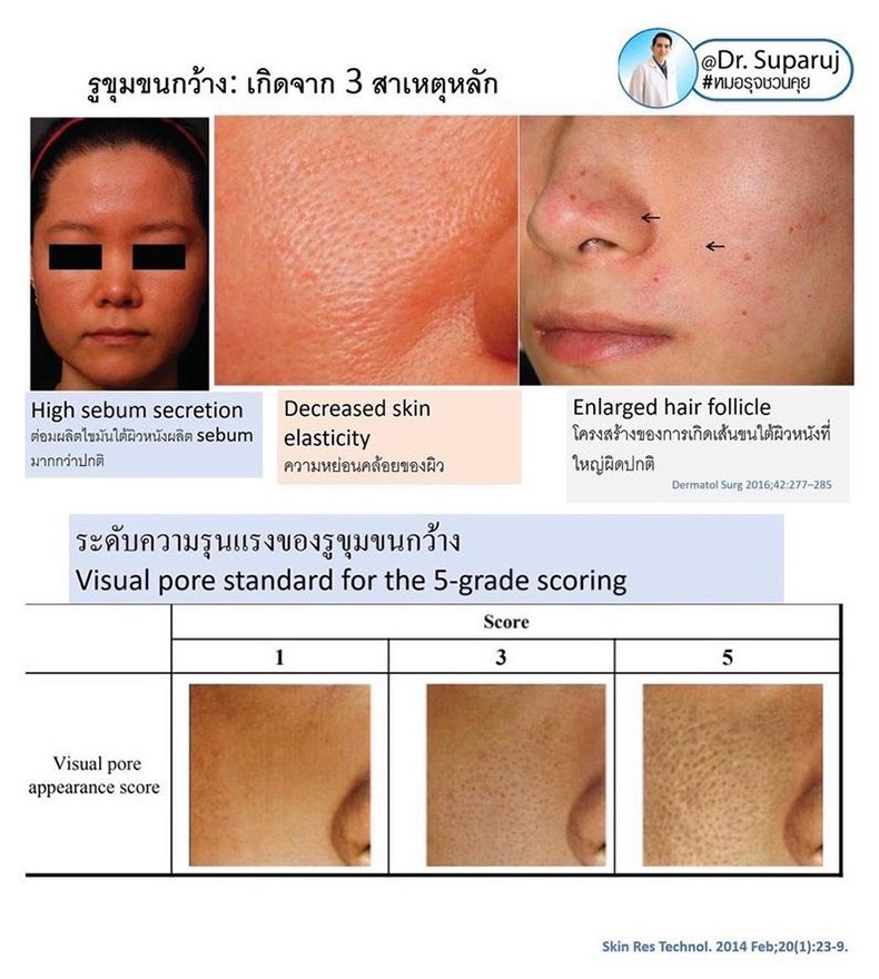 รูขุมขนกว้าง Enlarged Facial Pore เกิดจากอะไรและดูแลได้อย่างไร Part 3/3 รูขุมขนกว้าง Enlarged Facial Pore เกิดจากอะไรและดูแลได้อย่างไร Part 3/3