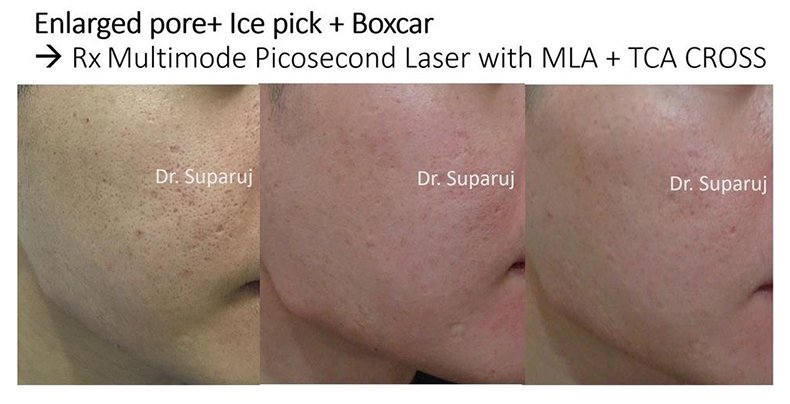 รูขุมขนกว้าง Enlarged Facial Pore เกิดจากอะไรและดูแลได้อย่างไร Part 3/3 รูขุมขนกว้าง Enlarged Facial Pore เกิดจากอะไรและดูแลได้อย่างไร Part 3/3