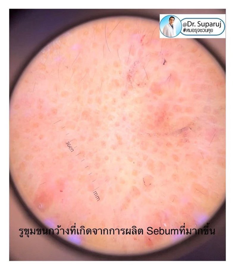 รูขุมขนกว้าง Enlarged Facial Pore เกิดจากอะไรและดูแลได้อย่างไร Part 3/3 รูขุมขนกว้าง Enlarged Facial Pore เกิดจากอะไรและดูแลได้อย่างไร Part 3/3
