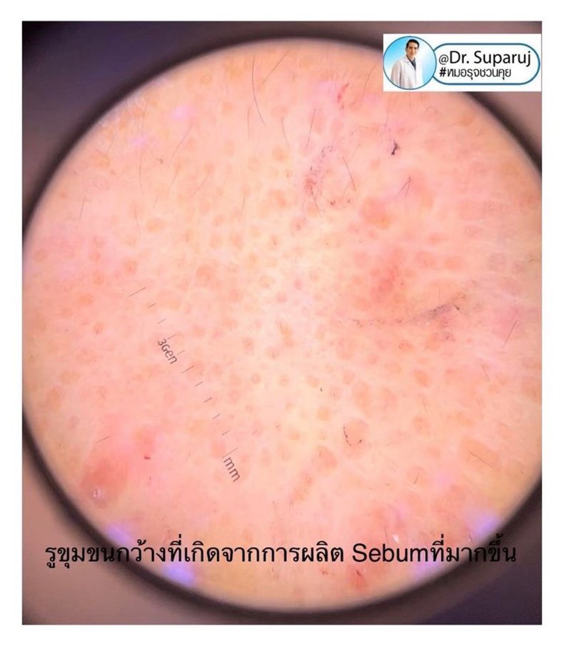 รูขุมขนกว้าง Enlarged Facial Pore เกิดจากอะไรและดูแลได้อย่างไร Part 3/3