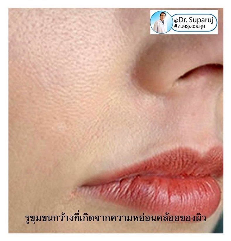 รูขุมขนกว้าง Enlarged Facial Pore เกิดจากอะไรและดูแลได้อย่างไร Part 3/3 รูขุมขนกว้าง Enlarged Facial Pore เกิดจากอะไรและดูแลได้อย่างไร Part 3/3