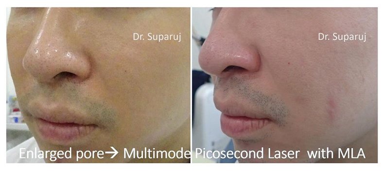 รูขุมขนกว้าง Enlarged Facial Pore เกิดจากอะไรและดูแลได้อย่างไร Part 3/3 รูขุมขนกว้าง Enlarged Facial Pore เกิดจากอะไรและดูแลได้อย่างไร Part 3/3