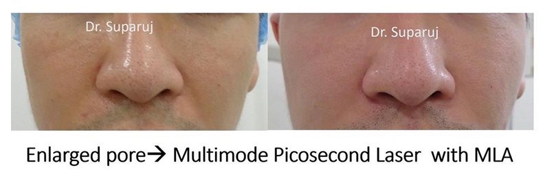 รูขุมขนกว้าง Enlarged Facial Pore เกิดจากอะไรและดูแลได้อย่างไร Part 3/3 รูขุมขนกว้าง Enlarged Facial Pore เกิดจากอะไรและดูแลได้อย่างไร Part 3/3