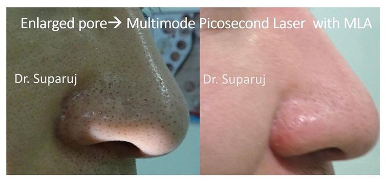 รูขุมขนกว้าง Enlarged Facial Pore เกิดจากอะไรและดูแลได้อย่างไร Part 3/3 รูขุมขนกว้าง Enlarged Facial Pore เกิดจากอะไรและดูแลได้อย่างไร Part 3/3