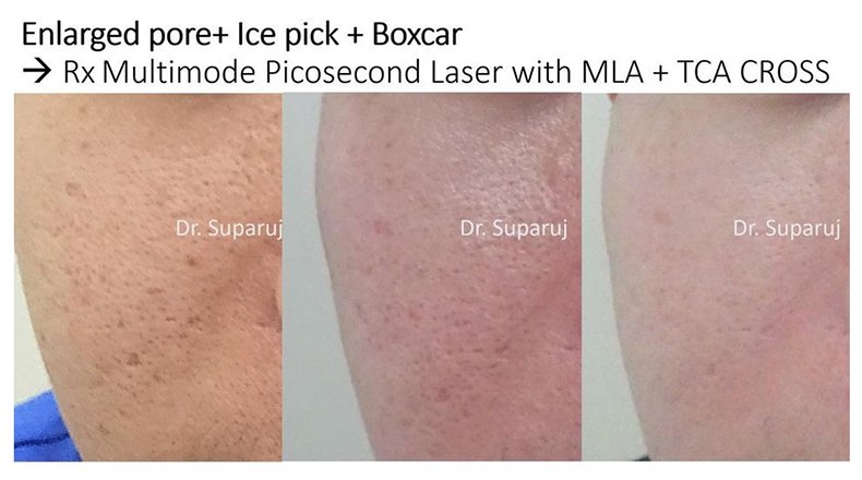 รูขุมขนกว้าง Enlarged Facial Pore เกิดจากอะไรและดูแลได้อย่างไร Part 3/3 รูขุมขนกว้าง Enlarged Facial Pore เกิดจากอะไรและดูแลได้อย่างไร Part 3/3