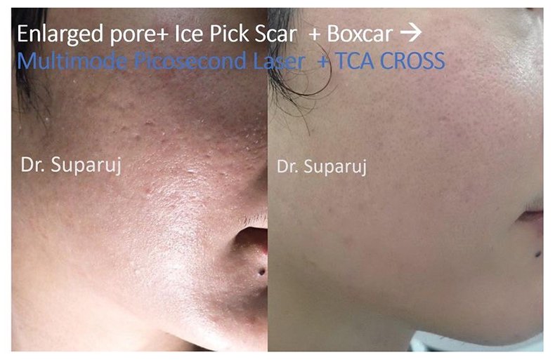 รูขุมขนกว้าง Enlarged Facial Pore เกิดจากอะไรและดูแลได้อย่างไร Part 3/3 รูขุมขนกว้าง Enlarged Facial Pore เกิดจากอะไรและดูแลได้อย่างไร Part 3/3
