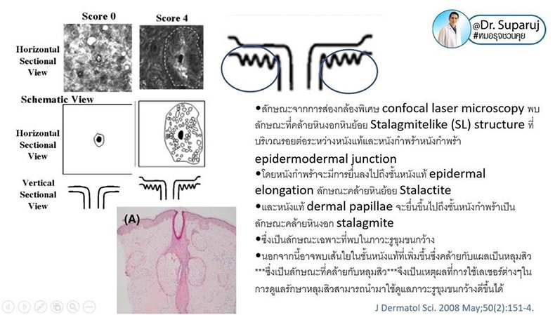 รูขุมขนกว้าง Enlarged Facial Pore เกิดจากอะไรและดูแลได้อย่างไร Part 3/3 รูขุมขนกว้าง Enlarged Facial Pore เกิดจากอะไรและดูแลได้อย่างไร Part 3/3
