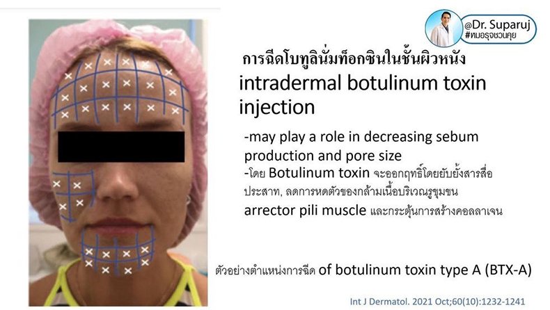 รูขุมขนกว้าง Enlarged Facial Pore เกิดจากอะไรและดูแลได้อย่างไร Part 3/3 รูขุมขนกว้าง Enlarged Facial Pore เกิดจากอะไรและดูแลได้อย่างไร Part 3/3