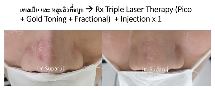 ดูแลแผลเป็นนูนคีลอยด์ ด้วยเทคนิค Fractional Ablative Laser+ทายา*โดยไม่ต้องฉีดยา* :Laser assisted drug delivery