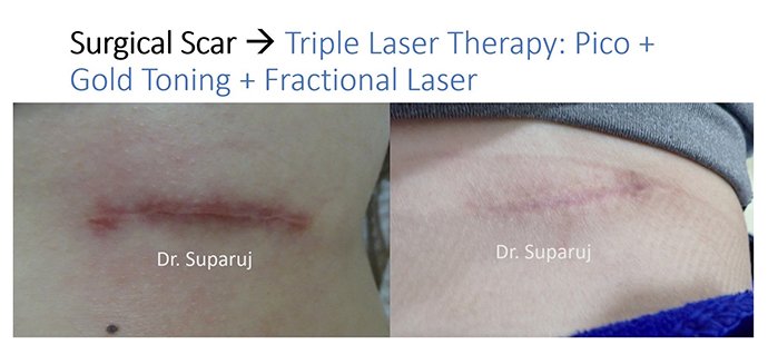 ดูแลแผลเป็นนูนคีลอยด์ ด้วยเทคนิค Fractional Ablative Laser+ทายา*โดยไม่ต้องฉีดยา* :Laser assisted drug delivery ดูแลแผลเป็นนูนคีลอยด์ ด้วยเทคนิค Fractional Ablative Laser+ทายา*โดยไม่ต้องฉีดยา* :Laser assisted drug delivery