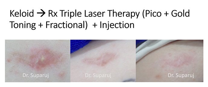 ดูแลแผลเป็นนูนคีลอยด์ ด้วยเทคนิค Fractional Ablative Laser+ทายา*โดยไม่ต้องฉีดยา* :Laser assisted drug delivery ดูแลแผลเป็นนูนคีลอยด์ ด้วยเทคนิค Fractional Ablative Laser+ทายา*โดยไม่ต้องฉีดยา* :Laser assisted drug delivery