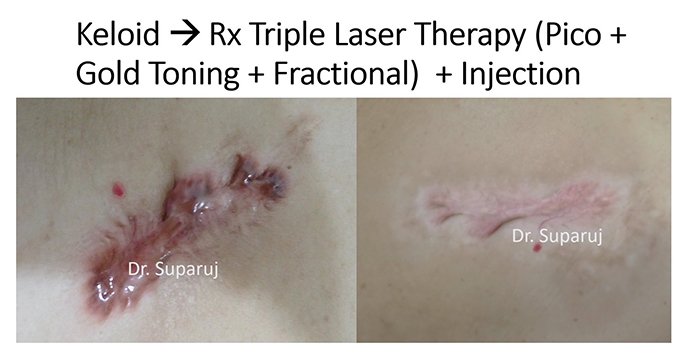 ดูแลแผลเป็นนูนคีลอยด์ ด้วยเทคนิค Fractional Ablative Laser+ทายา*โดยไม่ต้องฉีดยา* :Laser assisted drug delivery ดูแลแผลเป็นนูนคีลอยด์ ด้วยเทคนิค Fractional Ablative Laser+ทายา*โดยไม่ต้องฉีดยา* :Laser assisted drug delivery
