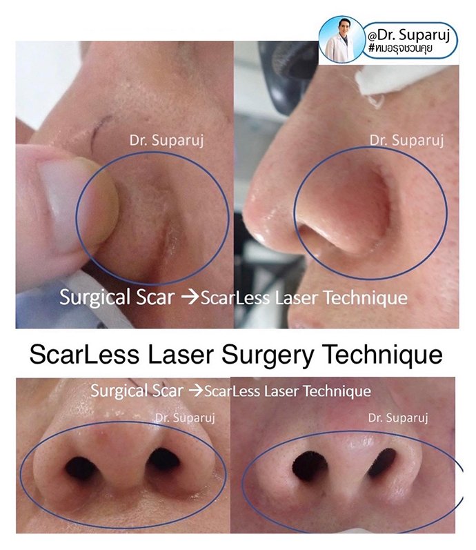 ดูแลแผลเป็นนูนคีลอยด์ ด้วยเทคนิค Fractional Ablative Laser+ทายา*โดยไม่ต้องฉีดยา* :Laser assisted drug delivery ดูแลแผลเป็นนูนคีลอยด์ ด้วยเทคนิค Fractional Ablative Laser+ทายา*โดยไม่ต้องฉีดยา* :Laser assisted drug delivery