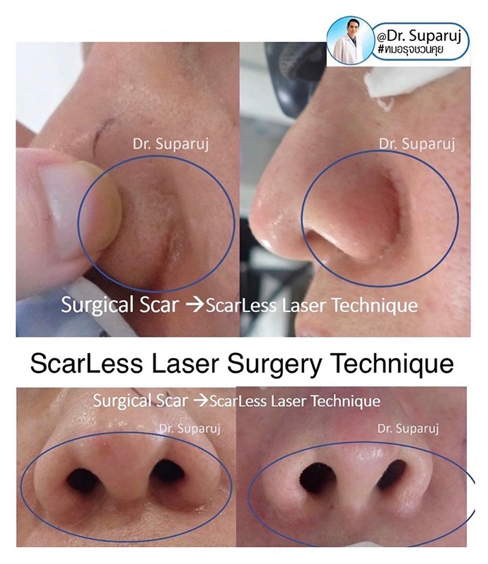 ดูแลแผลเป็นนูนคีลอยด์ ด้วยเทคนิค Fractional Ablative Laser+ทายา*โดยไม่ต้องฉีดยา* :Laser assisted drug delivery