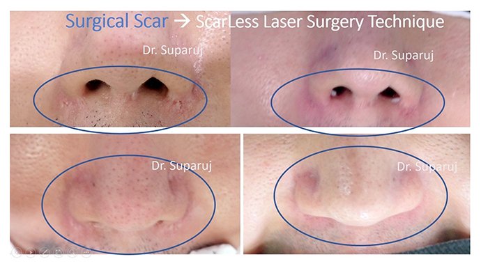 ดูแลแผลเป็นนูนคีลอยด์ ด้วยเทคนิค Fractional Ablative Laser+ทายา*โดยไม่ต้องฉีดยา* :Laser assisted drug delivery ดูแลแผลเป็นนูนคีลอยด์ ด้วยเทคนิค Fractional Ablative Laser+ทายา*โดยไม่ต้องฉีดยา* :Laser assisted drug delivery