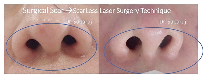 ดูแลแผลเป็นนูนคีลอยด์ ด้วยเทคนิค Fractional Ablative Laser+ทายา*โดยไม่ต้องฉีดยา* :Laser assisted drug delivery ดูแลแผลเป็นนูนคีลอยด์ ด้วยเทคนิค Fractional Ablative Laser+ทายา*โดยไม่ต้องฉีดยา* :Laser assisted drug delivery