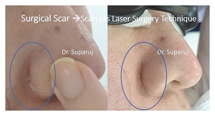 ดูแลแผลเป็นนูนคีลอยด์ ด้วยเทคนิค Fractional Ablative Laser+ทายา*โดยไม่ต้องฉีดยา* :Laser assisted drug delivery ดูแลแผลเป็นนูนคีลอยด์ ด้วยเทคนิค Fractional Ablative Laser+ทายา*โดยไม่ต้องฉีดยา* :Laser assisted drug delivery