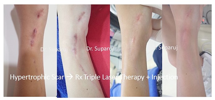 ดูแลแผลเป็นนูนคีลอยด์ ด้วยเทคนิค Fractional Ablative Laser+ทายา*โดยไม่ต้องฉีดยา* :Laser assisted drug delivery