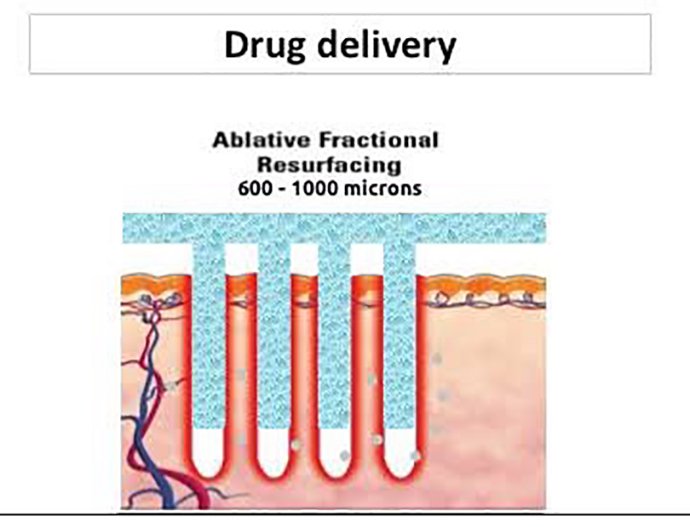 ดูแลแผลเป็นนูนคีลอยด์ ด้วยเทคนิค Fractional Ablative Laser+ทายา*โดยไม่ต้องฉีดยา* :Laser assisted drug delivery ดูแลแผลเป็นนูนคีลอยด์ ด้วยเทคนิค Fractional Ablative Laser+ทายา*โดยไม่ต้องฉีดยา* :Laser assisted drug delivery