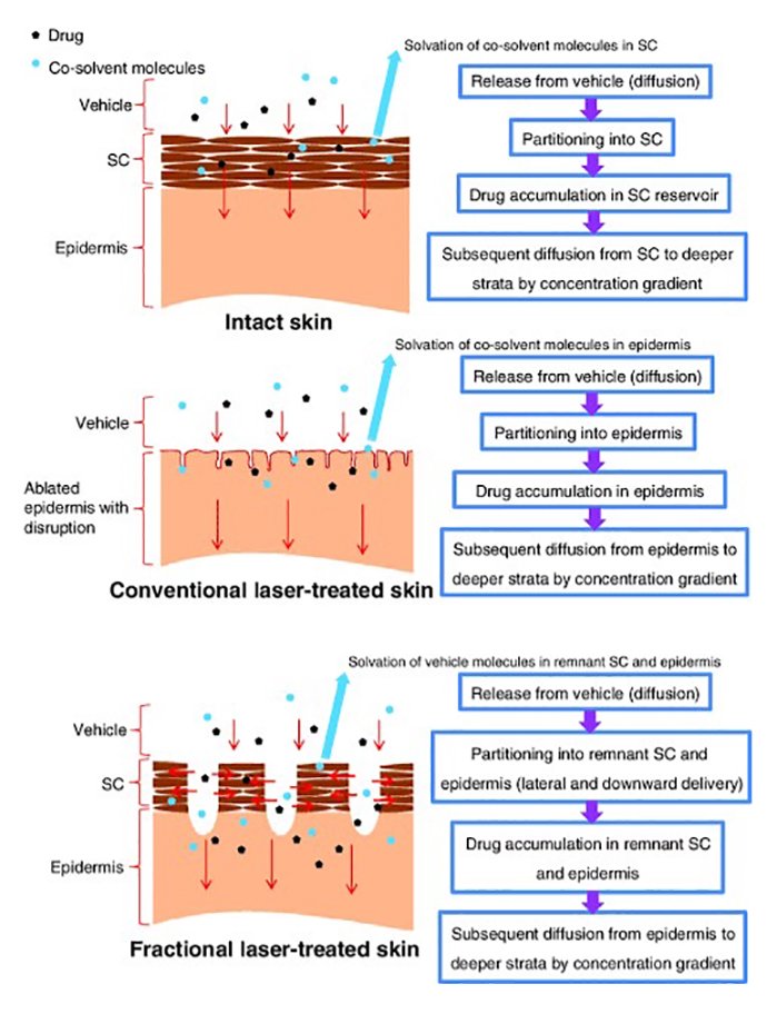 ดูแลแผลเป็นนูนคีลอยด์ ด้วยเทคนิค Fractional Ablative Laser+ทายา*โดยไม่ต้องฉีดยา* :Laser assisted drug delivery ดูแลแผลเป็นนูนคีลอยด์ ด้วยเทคนิค Fractional Ablative Laser+ทายา*โดยไม่ต้องฉีดยา* :Laser assisted drug delivery
