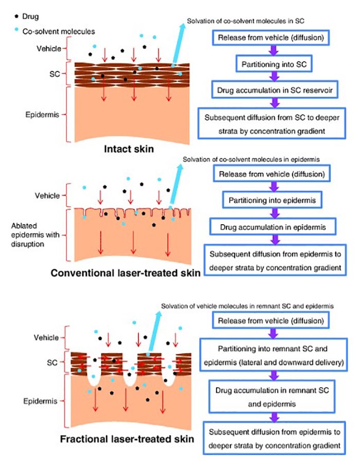 ดูแลแผลเป็นนูนคีลอยด์ ด้วยเทคนิค Fractional Ablative Laser+ทายา*โดยไม่ต้องฉีดยา* :Laser assisted drug delivery