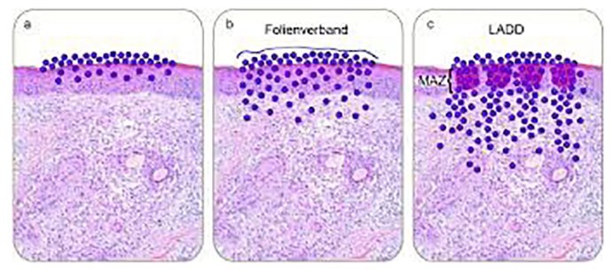 ดูแลแผลเป็นนูนคีลอยด์ ด้วยเทคนิค Fractional Ablative Laser+ทายา*โดยไม่ต้องฉีดยา* :Laser assisted drug delivery ดูแลแผลเป็นนูนคีลอยด์ ด้วยเทคนิค Fractional Ablative Laser+ทายา*โดยไม่ต้องฉีดยา* :Laser assisted drug delivery