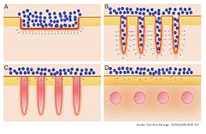 ดูแลแผลเป็นนูนคีลอยด์ ด้วยเทคนิค Fractional Ablative Laser+ทายา*โดยไม่ต้องฉีดยา* :Laser assisted drug delivery ดูแลแผลเป็นนูนคีลอยด์ ด้วยเทคนิค Fractional Ablative Laser+ทายา*โดยไม่ต้องฉีดยา* :Laser assisted drug delivery