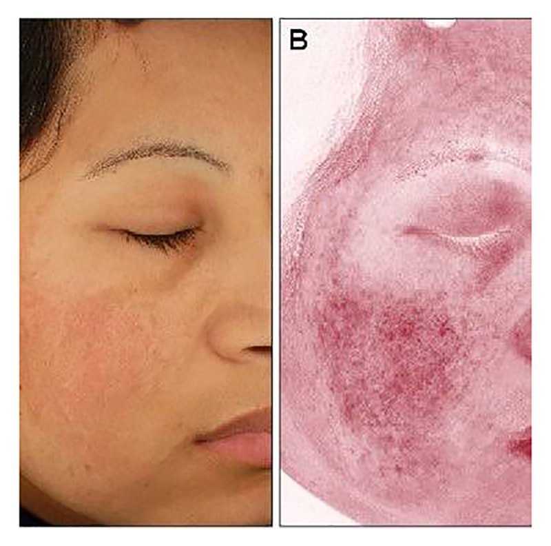 ฝ้าเลือด Telangiectatic Melasma ดูแลได้อย่างไร? ฝ้าเลือด Telangiectatic Melasma ดูแลได้อย่างไร?
