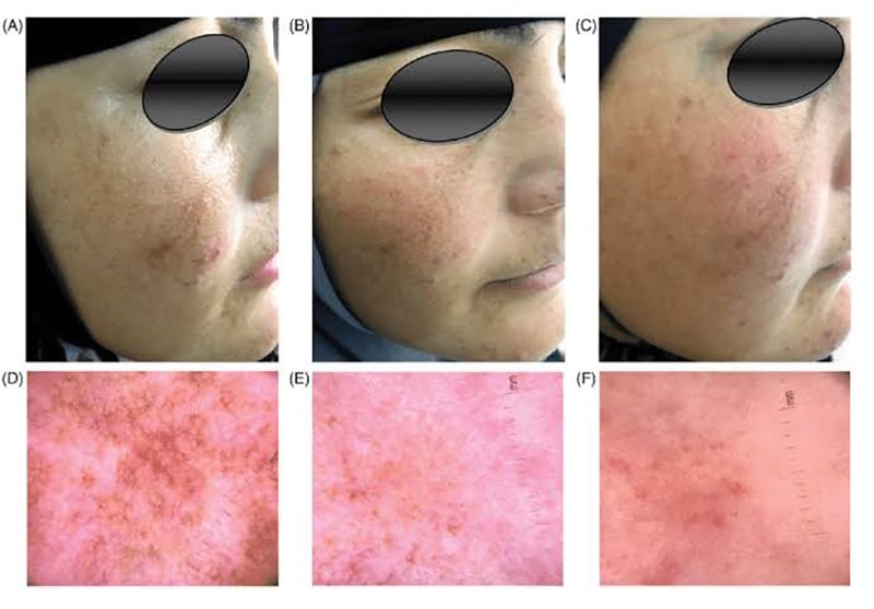 ฝ้าเลือด Telangiectatic Melasma ดูแลได้อย่างไร? ฝ้าเลือด Telangiectatic Melasma ดูแลได้อย่างไร?