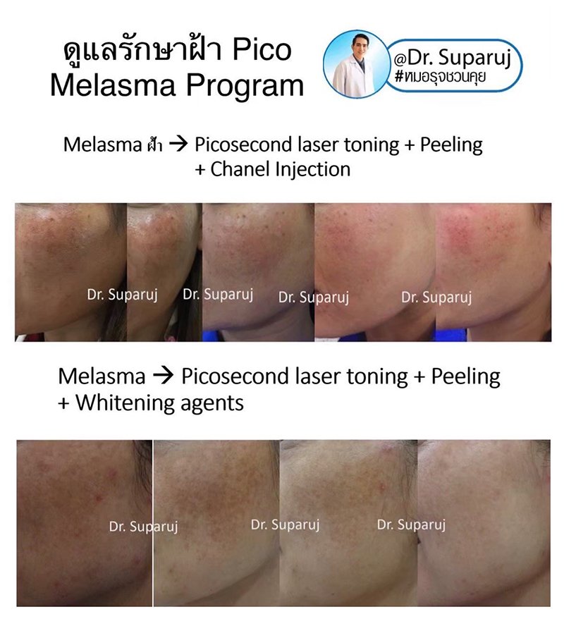 ฝ้าเลือด Telangiectatic Melasma ดูแลได้อย่างไร?