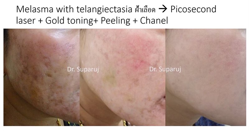 ฝ้าเลือด Telangiectatic Melasma ดูแลได้อย่างไร? ฝ้าเลือด Telangiectatic Melasma ดูแลได้อย่างไร?