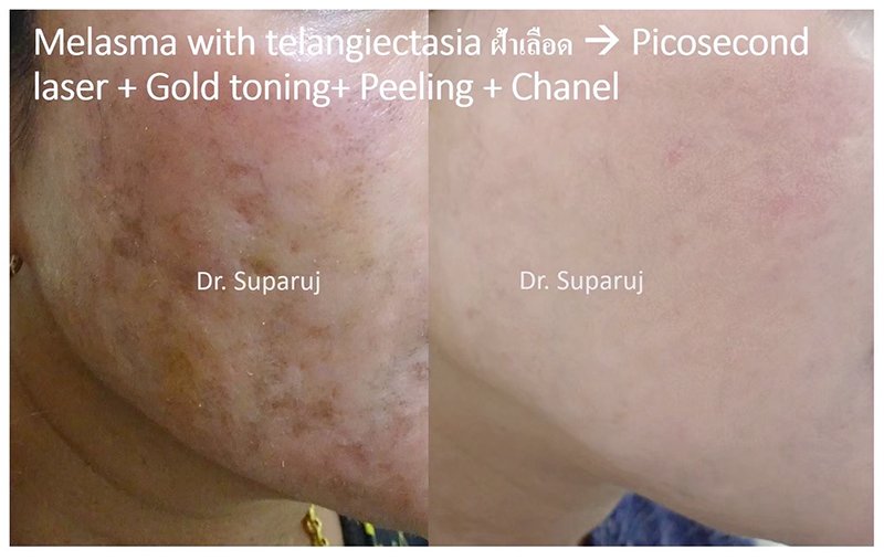 ฝ้าเลือด Telangiectatic Melasma ดูแลได้อย่างไร? ฝ้าเลือด Telangiectatic Melasma ดูแลได้อย่างไร?