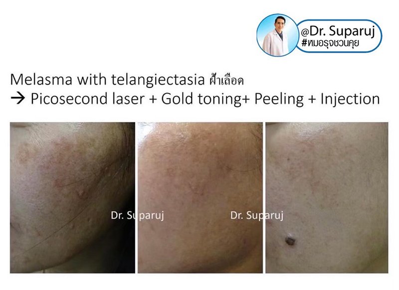 ฝ้าเลือด Telangiectatic Melasma ดูแลได้อย่างไร? ฝ้าเลือด Telangiectatic Melasma ดูแลได้อย่างไร?