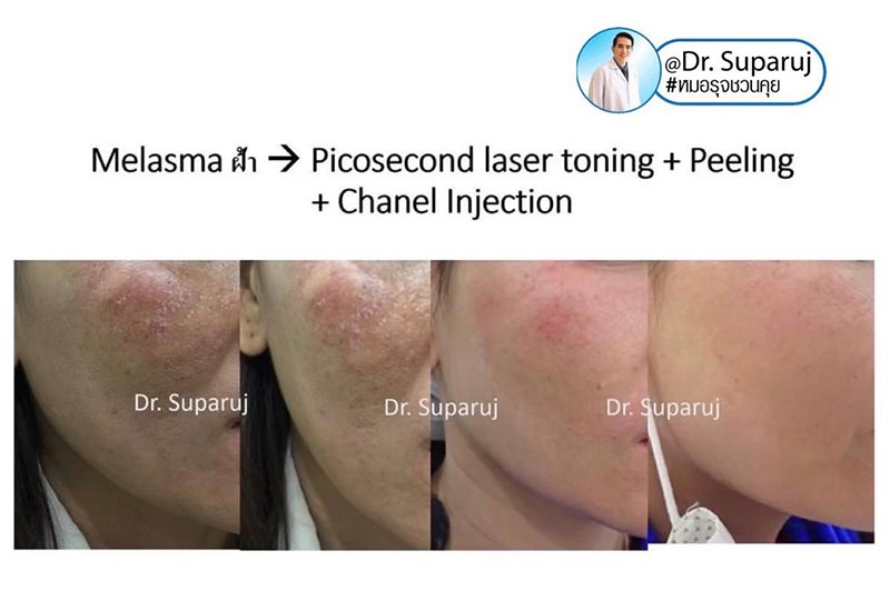 ฝ้าเลือด Telangiectatic Melasma ดูแลได้อย่างไร?