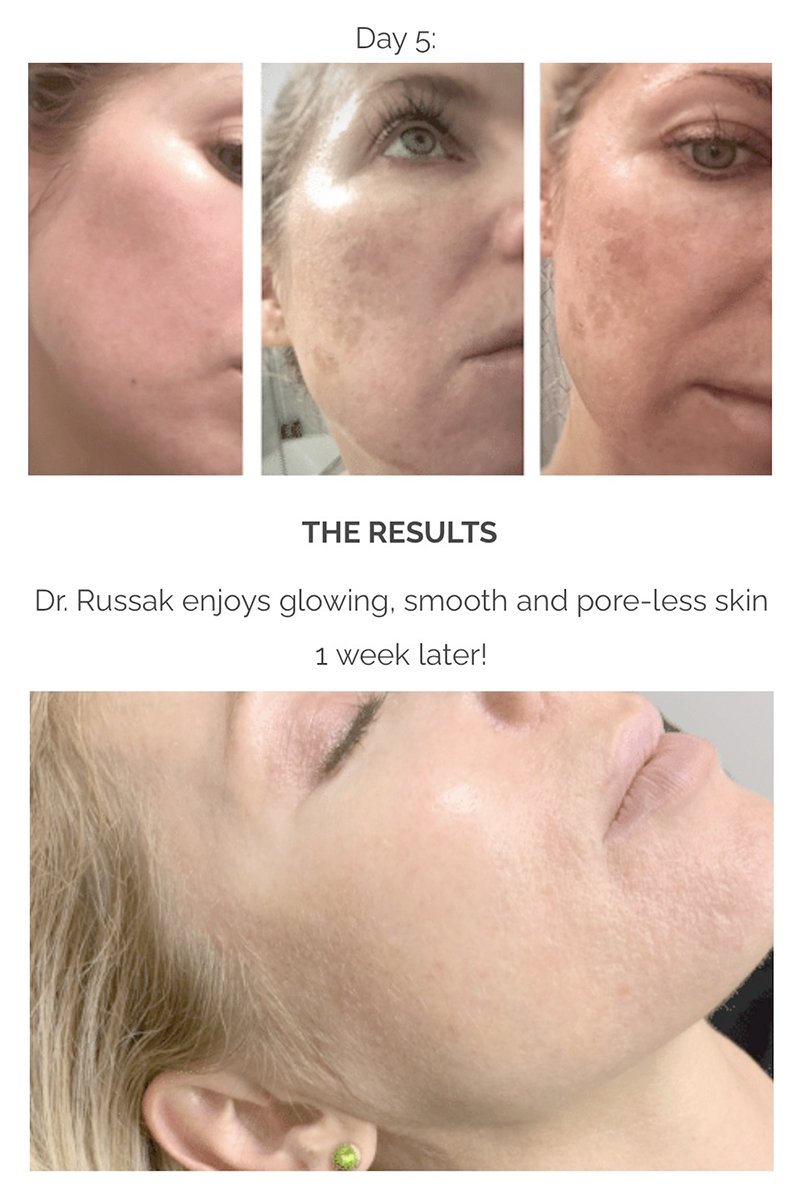 ฝ้าเลือด Telangiectatic Melasma ดูแลได้อย่างไร? ฝ้าเลือด Telangiectatic Melasma ดูแลได้อย่างไร?