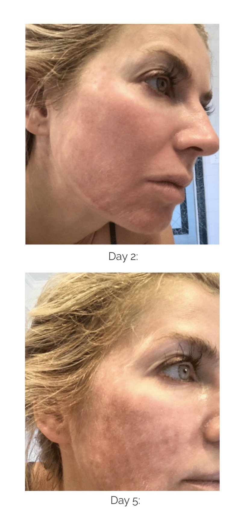 ฝ้าเลือด Telangiectatic Melasma ดูแลได้อย่างไร? ฝ้าเลือด Telangiectatic Melasma ดูแลได้อย่างไร?